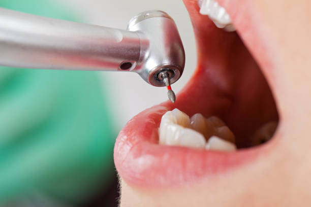 Best Emergency Wisdom Tooth Extraction in Mount Gilead, OH